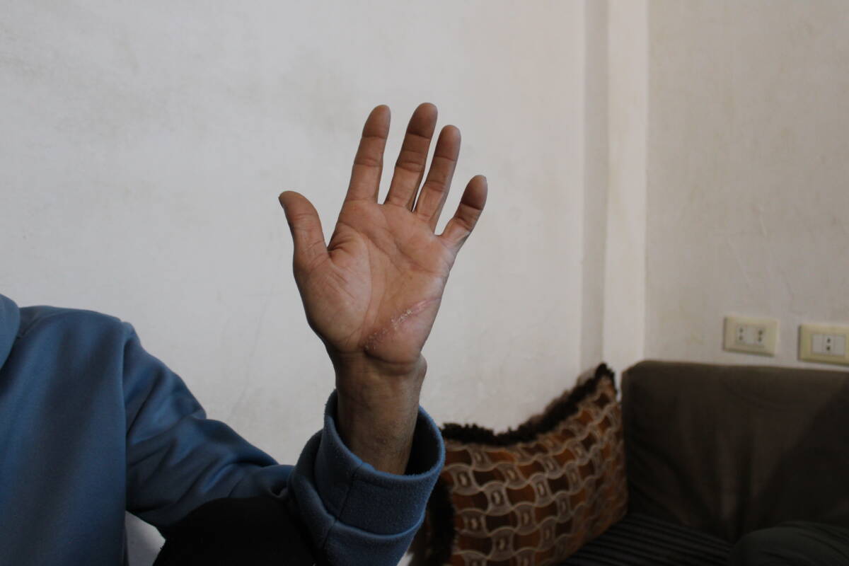 A scar on Issa Muhammad Othman’s left hand from a recent attack, 27/02/2024 (Hanna Davis/Syria Direct)